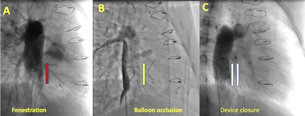 Medica Superspecialty Hospital uses unique innovative rotational angiogram for the first time to treat congenital structural heart disease