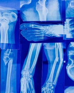 Poor Lifestyle Choices Double The Risk of Arthritis: Warn Doctors