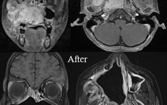 X-Ray of the Nasal Tumor