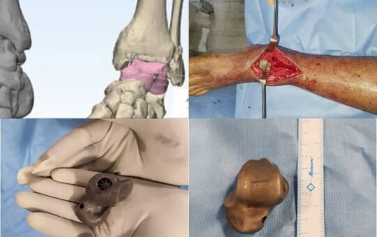 _mutilated ankle joint by a tumour