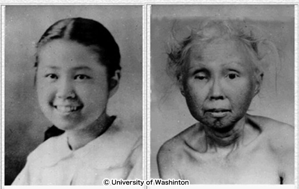 Werner Syndrome (WS)